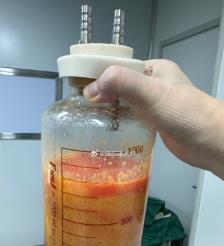 怒江水动力吸脂手术要做多久？